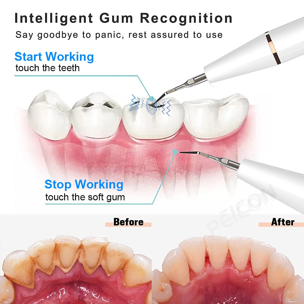 Electric Teeth Stain and Plaque Remover